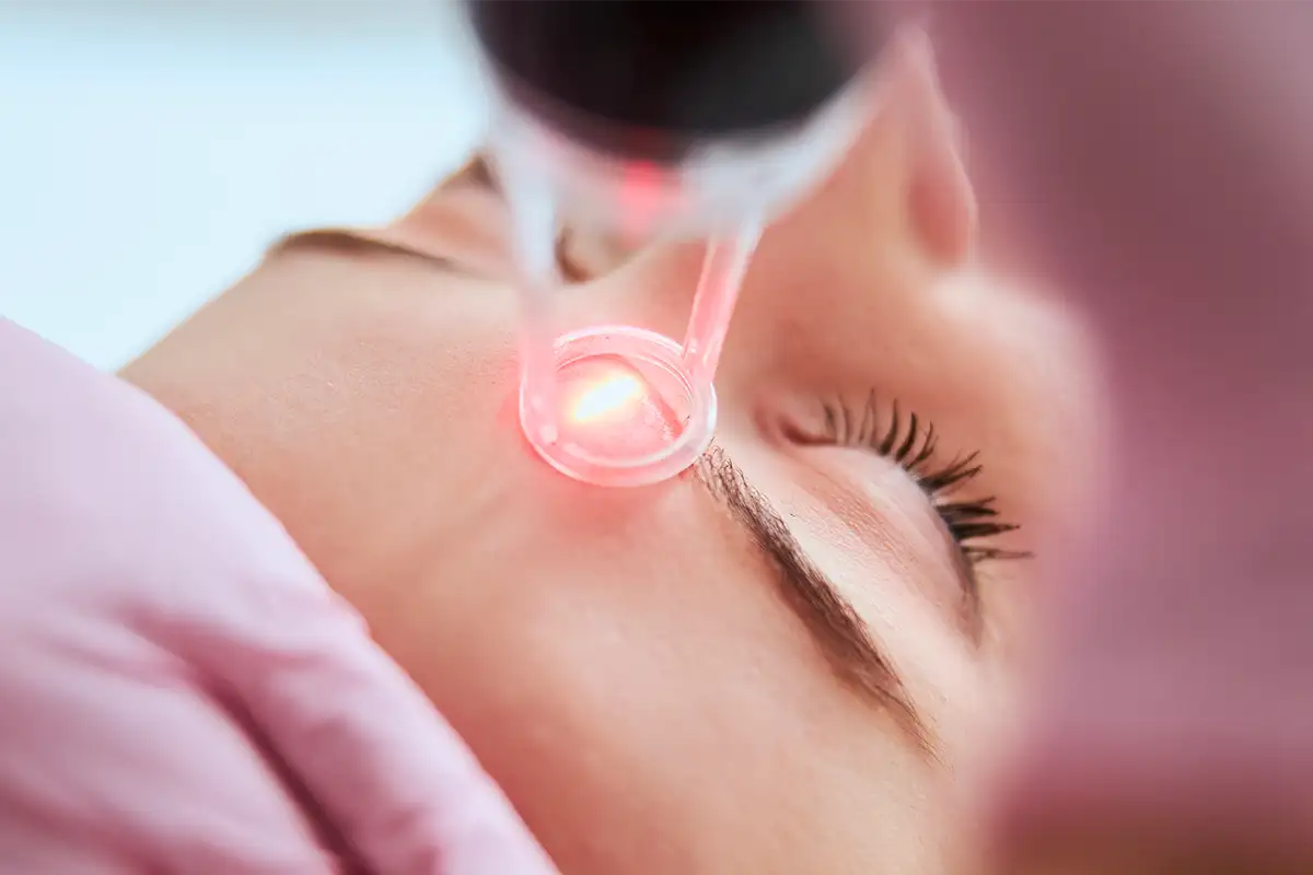 Laserbehandlung im Gesicht einer Frau beim Hautarzt